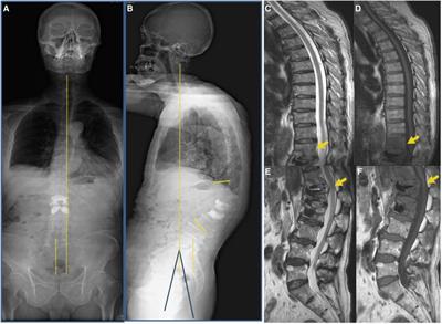 Surgical Correction of Kyphosis in Patients With Camptocormia Associated With Parkinson’s Disease: A Case Report and Review of the Literature